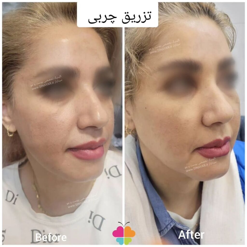 تزریق چربی صورت در اصفهان