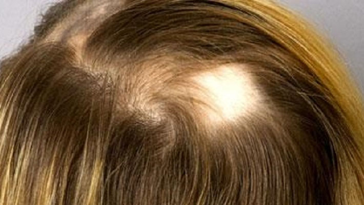 روش های درمان ریزش موی سکه ای