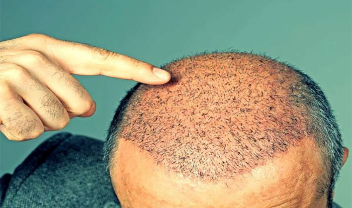 علت ریزش مو بعد از کاشت