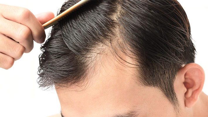 بالاترین تراکم کاشت مو چقدر است؟