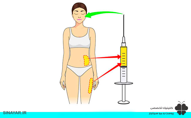 تزریق چربی چگونه انجام می شود