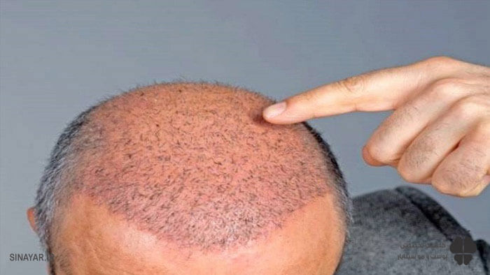 عوارض استفاده از شامپوهای نامناسب بعد از کاشت مو