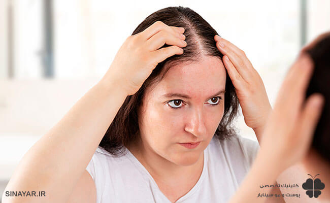 کاشت مو برای افرادی با ریزش مو ارثی (آلوپسی آندروژنیک)