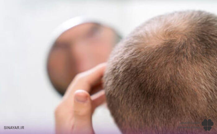 عوارض روش نادرست خوابیدن بعد از کاشت مو