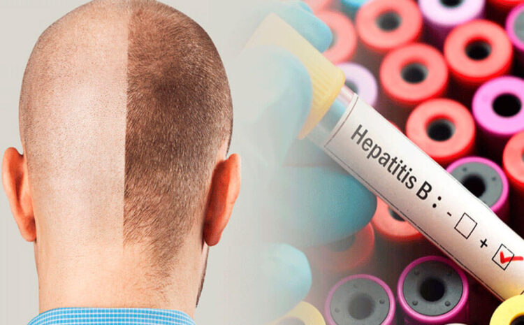 کاشت مو برای افراد هپاتیتی