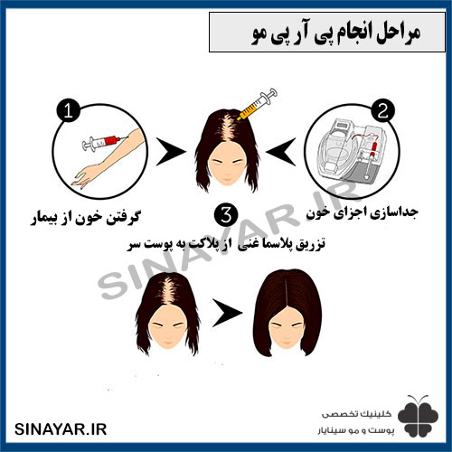 پی آر پی مو نی نی سایت