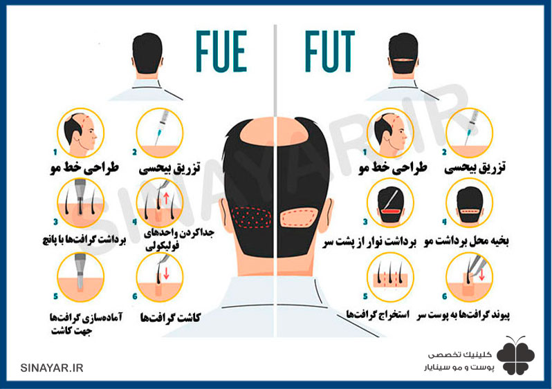 تفاوت کاشت مو FUT با روش FIT