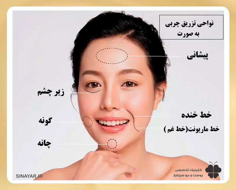 نتیجه تزریق چربی به صورت نی نی سایت