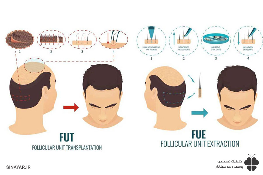 کاشت مو به روش فوق ترکیبی 