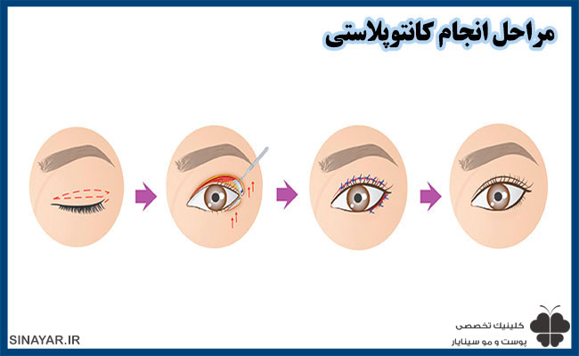 کانتوپلاستی نی نی سایت 