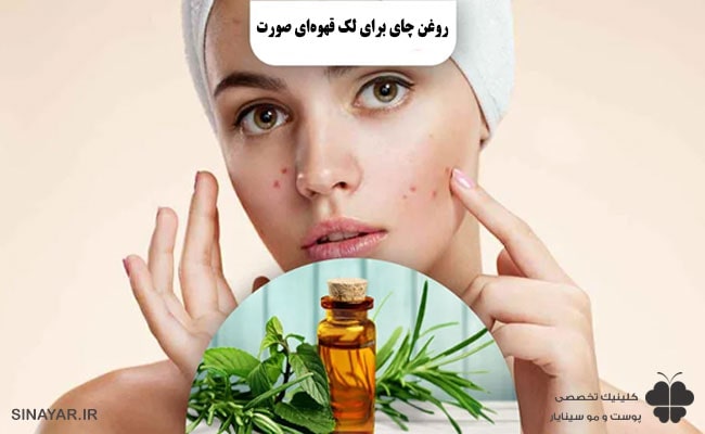 طرز استفاده روغن درخت چای برای لک قهوه ای صورت 