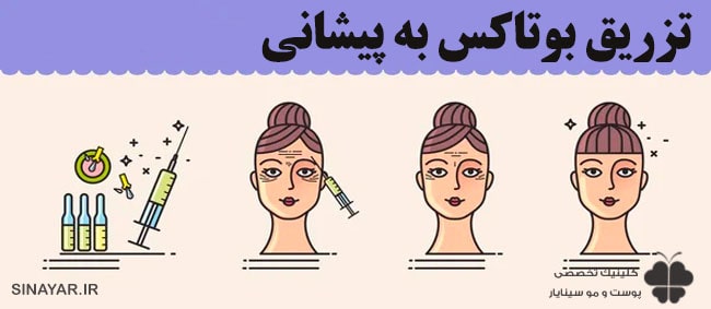 عکس قبل و بعد بوتاکس پیشانی 