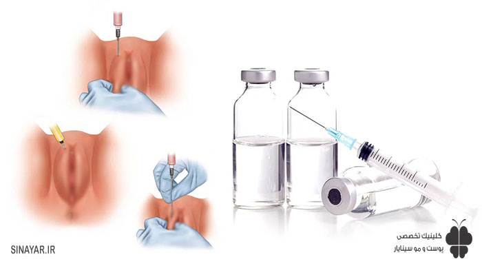 عکس تزریق ژل به واژن