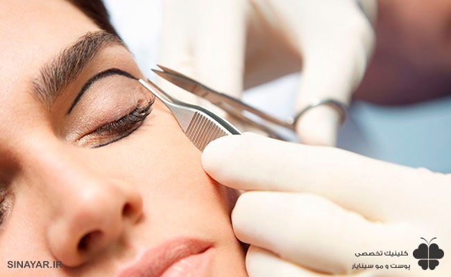 عوارض برداشتن پف پشت چشم