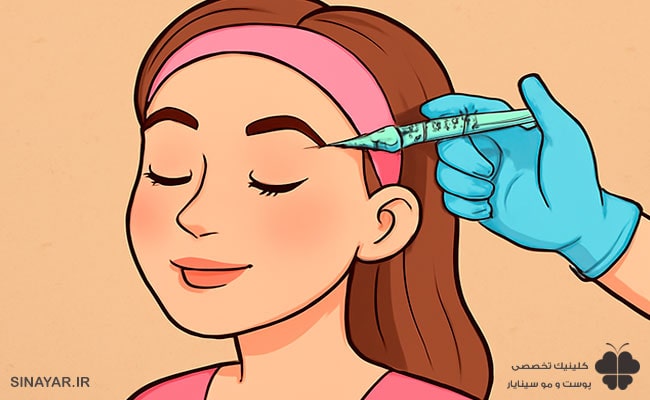 فیلر شقیقه برای بالا بردن ابرو