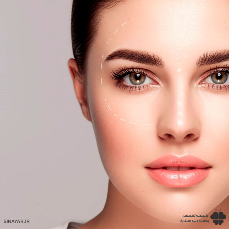 تزریق ژل شقیقه اصفهان