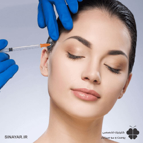 فیلر لیفت شقیقه