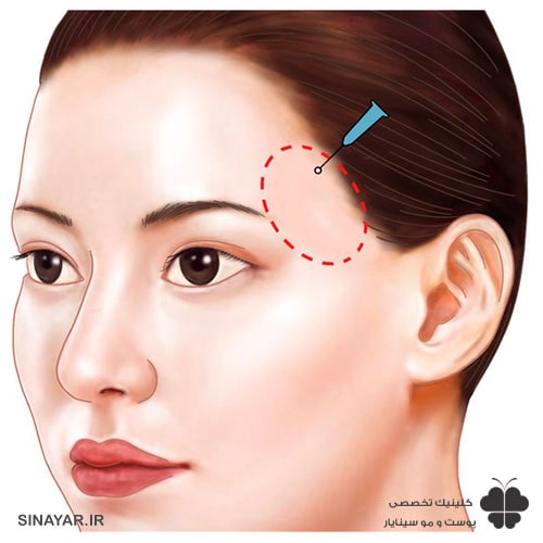 ماندگاری تزریق ژل شقیقه 
