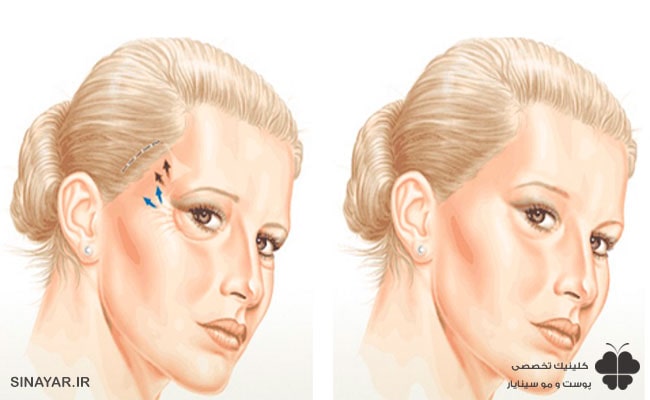 لیفت شقیقه با نخ عوارض دارد