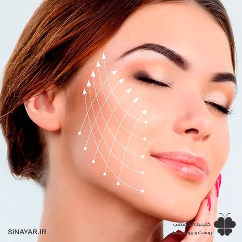 عوارض لیفت شقیقه با نخ