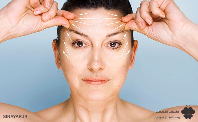 عوارض لیفت شقیقه با نخ