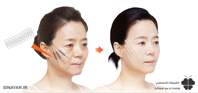 عوارض وحشتناک لیفت شقیقه با نخ