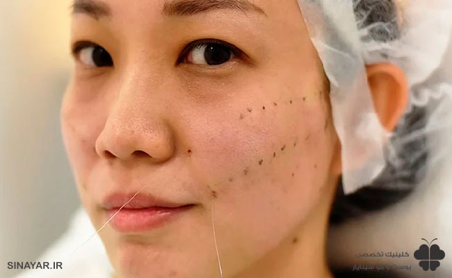 بررسی عوارض لیفت با نخ