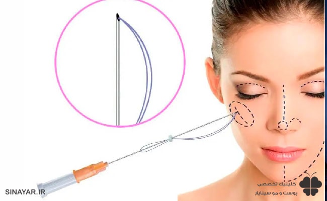 دوره نقاهت لیفت با نخ چقدر است؟