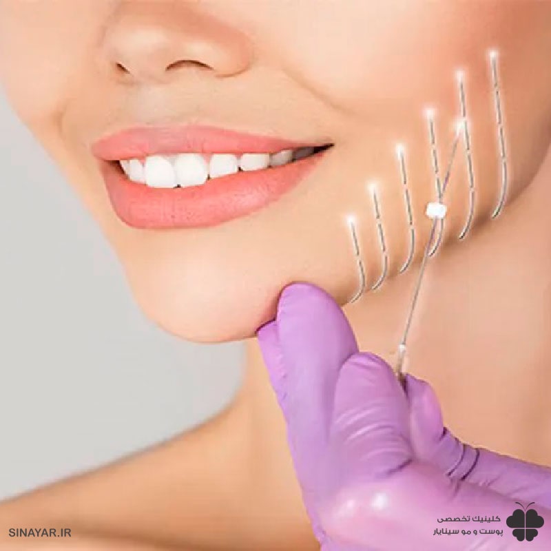 دوره نقاهت لیفت با نخ چقدر است؟