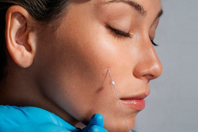 فرو رفتگی بعد لیفت با نخ