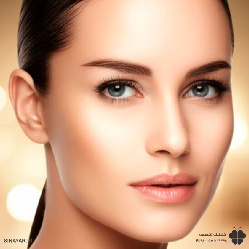 لیفت شقیقه با نخ