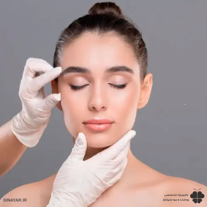 لیفت شقیقه با نخ چقدر ماندگاری دارد