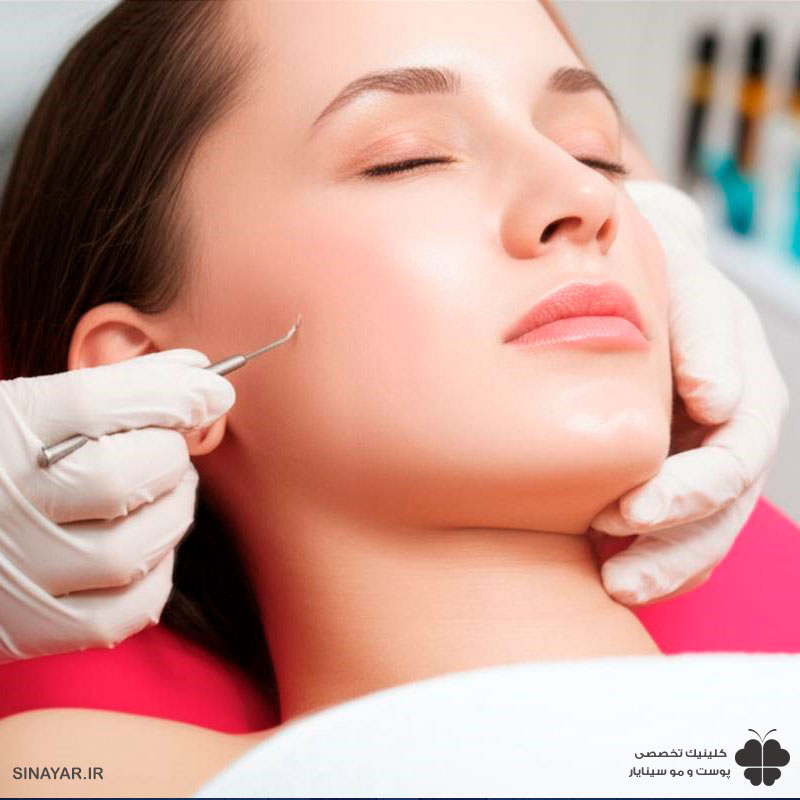 ماندگاری لیفت با نخ صورت