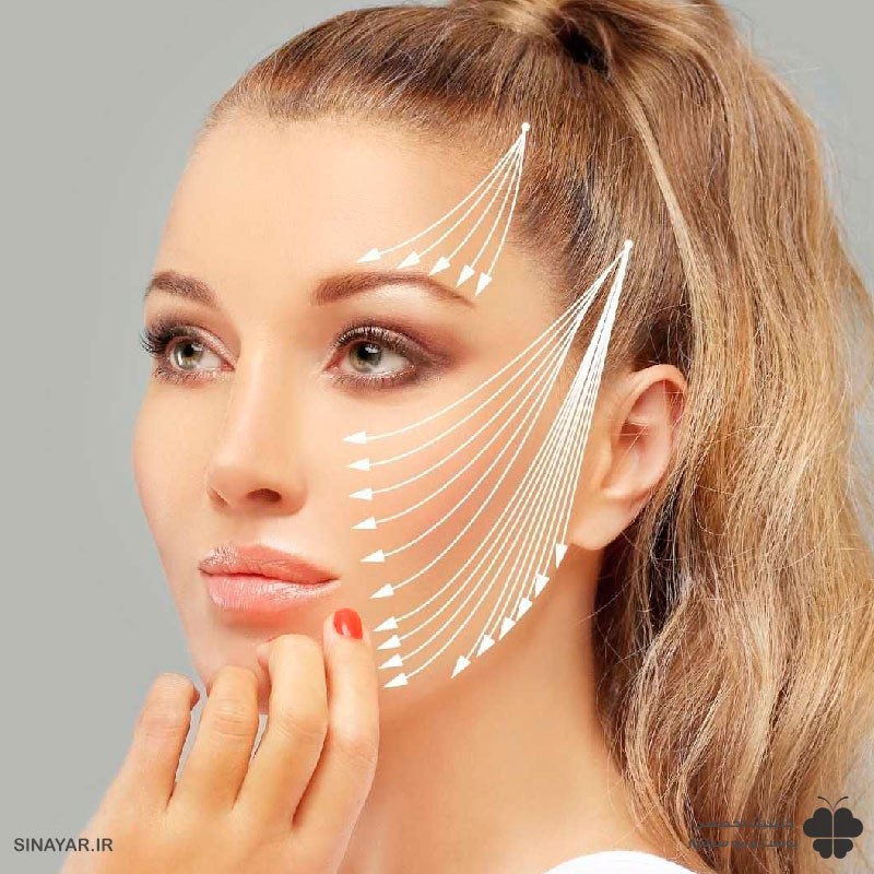 ماندگاری لیفت شقیقه با نخ