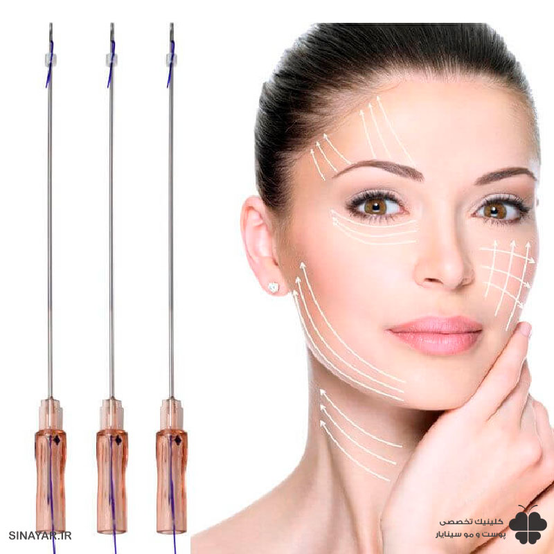 مدت زمان ماندگاری لیفت با نخ