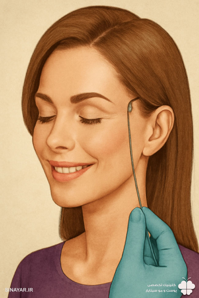 مدت زمان ماندگاری لیفت شقیقه با نخ چقدر خواهد بود