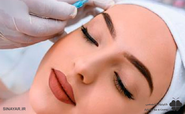 مدت زمان ماندگاری لیفت شقیقه با نخ