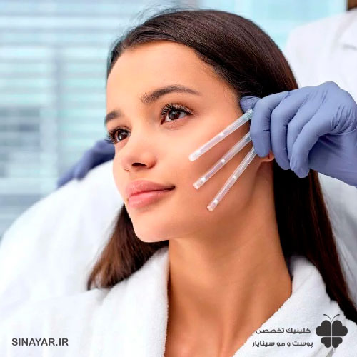 مدت ماندگاری لیفت با نخ