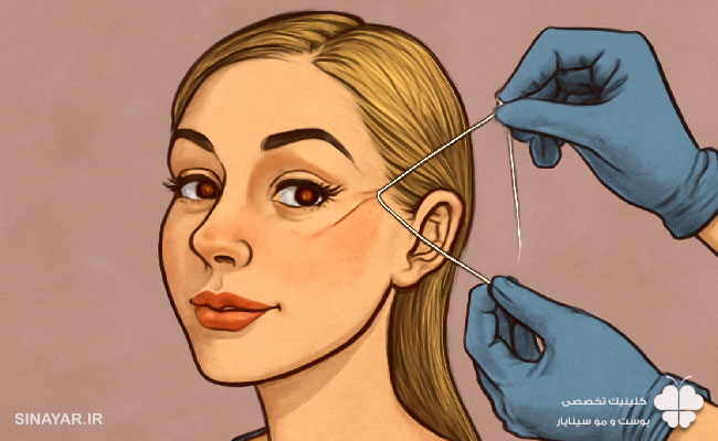 مراحل انجام لیفت شقیقه با نخ