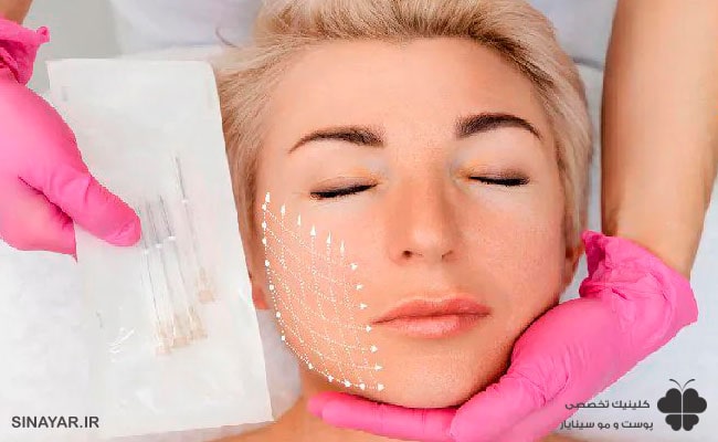 خوابیدن بعد از لیفت با نخ