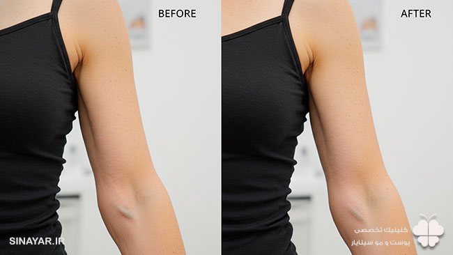 هزینه لیفت بازو با نخ