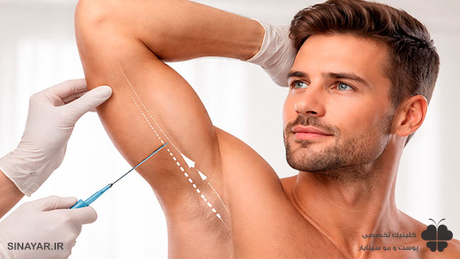 لیفت بازو با نخ