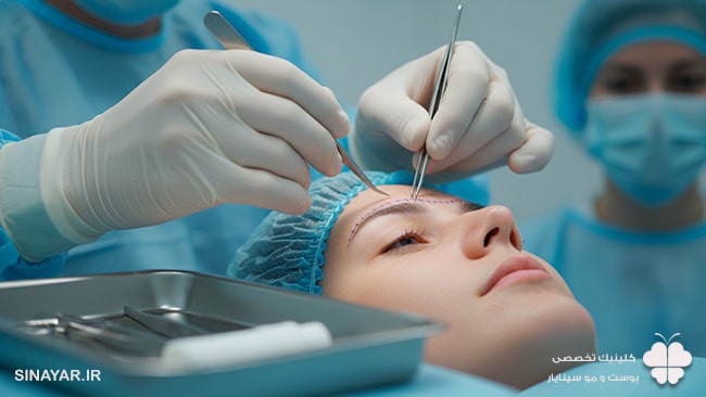 هزینه لیفت ابرو با نخ در اصفهان