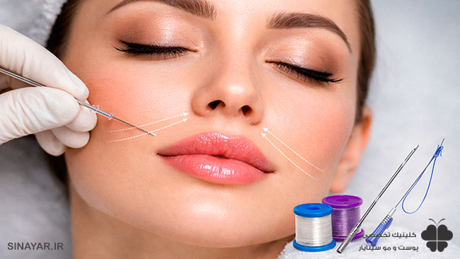 لیفت لب بالا با نخ