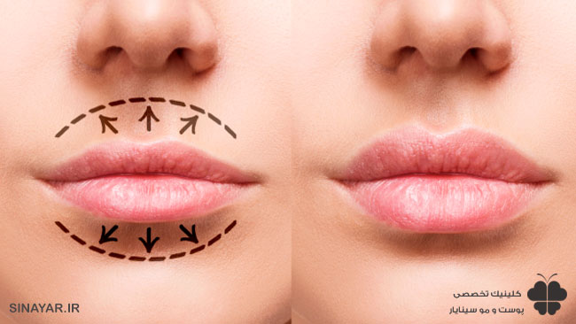 لیفت لب با نخ بدون جراحی