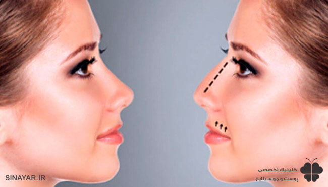 لیفت بینی با نخ عوارض دارد