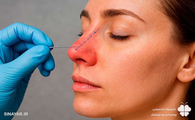 عوارض لیفت بینی با نخ