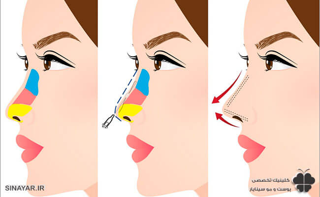 آیا لیفت بینی با نخ عوارض دارد