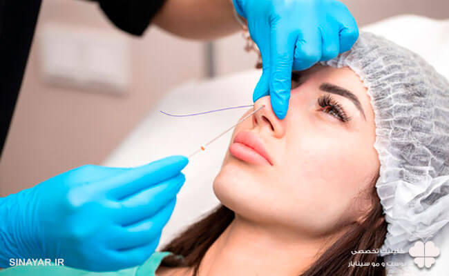 لیفت بینی با نخ چقدر ماندگاری دارد