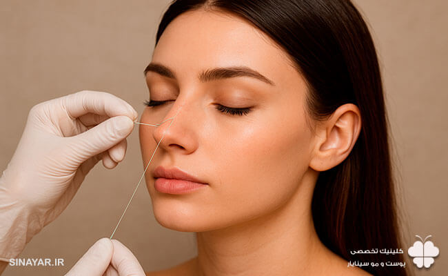 مدت ماندگاری لیفت بینی با نخ